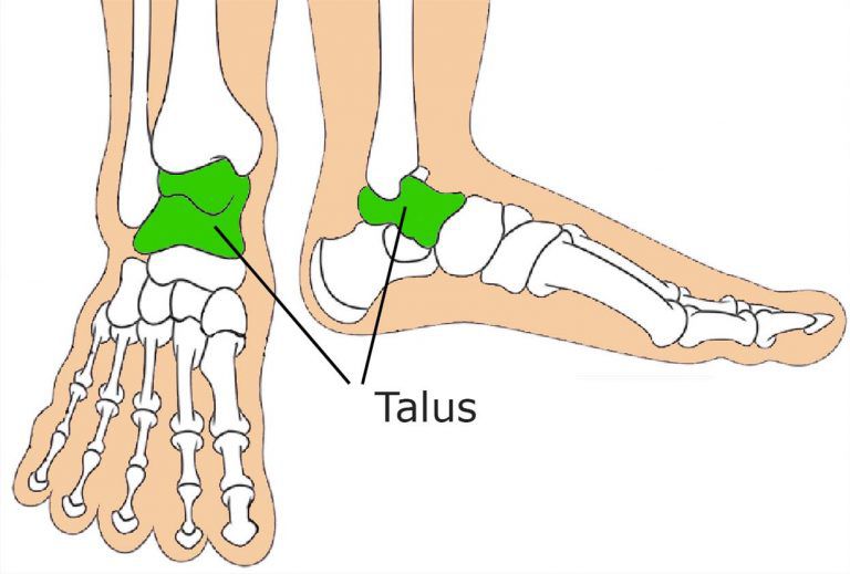 Congenital Vertical Talus Prof Nicola Portinaro Orthopedic Suregon